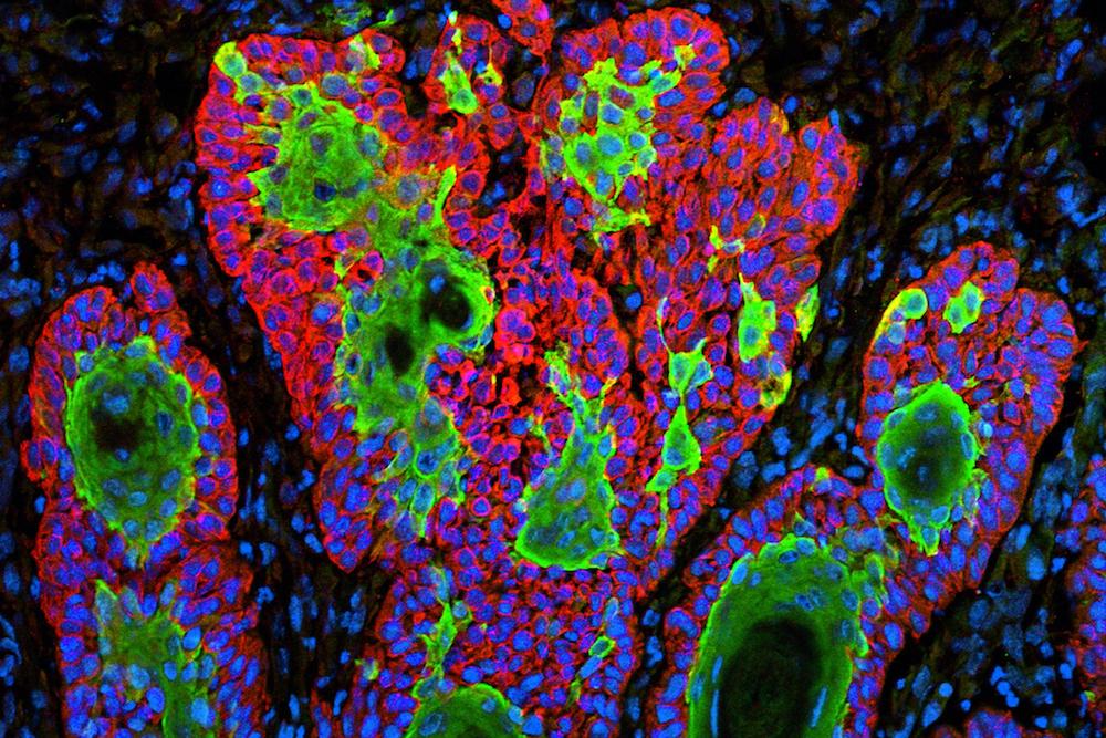 Fighting Cancer During COVID Taught Me About Our Strange Relationship With Disease | Zocalo Public Square • Arizona State University • Smithsonian